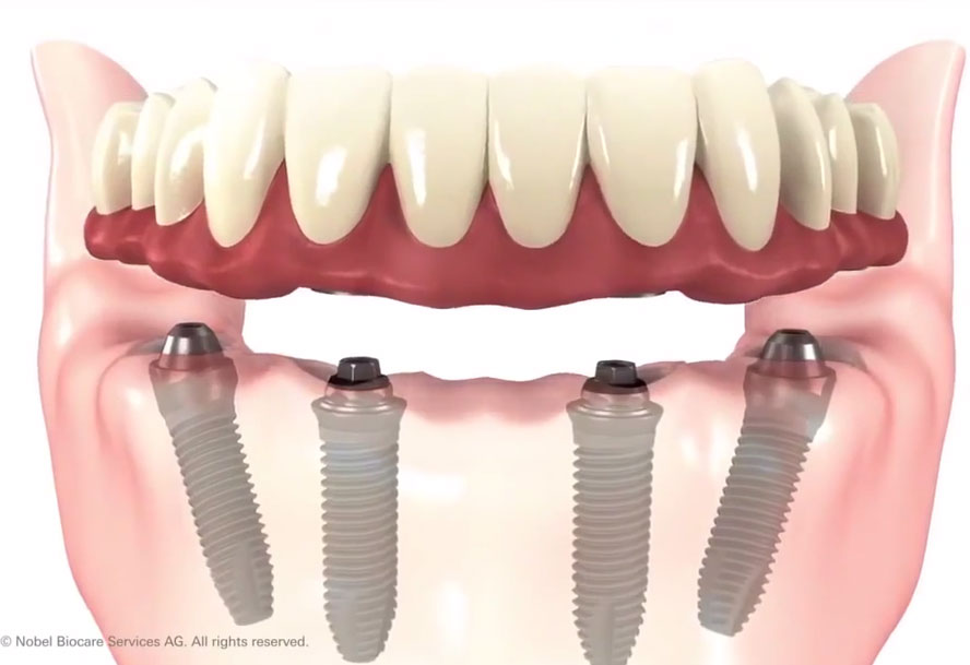 Dental Implant Restoration St. Johns, MI