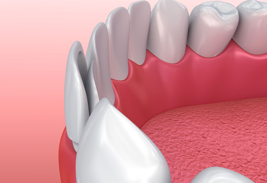 Dental Veneers St. Johns, MI
