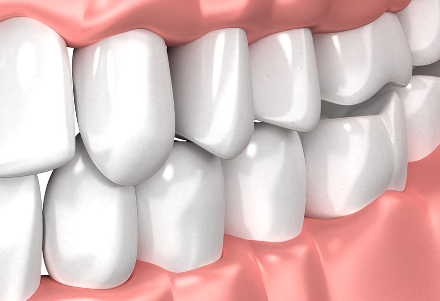 Teeth Whitening St. Johns, MI